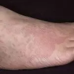 гранулема на ноге